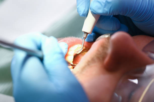 Best Emergency Wisdom Teeth Removal in Peachtree City, GA
